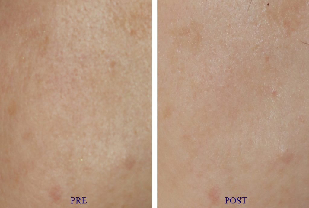 Before & after Carbon laser for pores