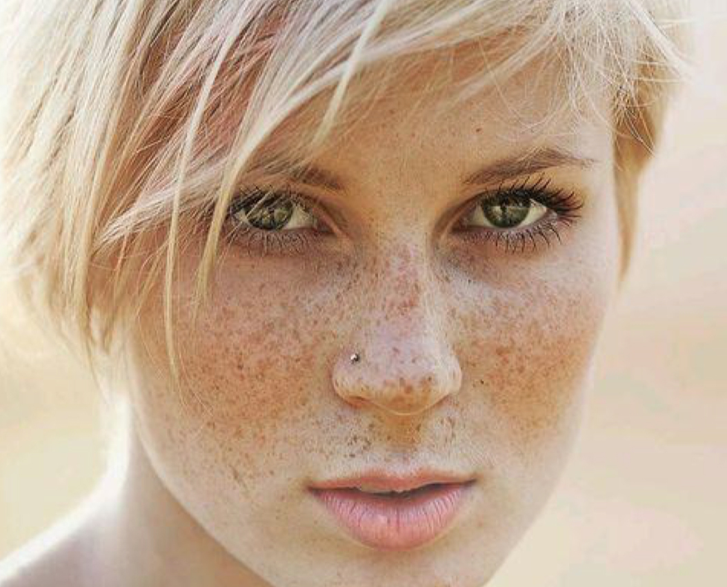 Freckles appear in childhood on the forehead, nose, cheek and can affect th...