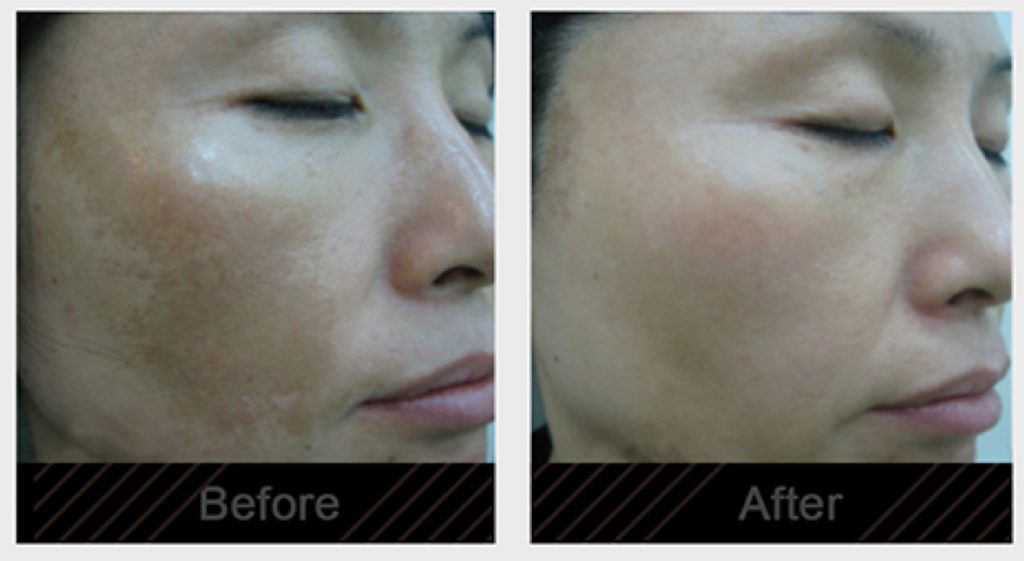 Melasma before and after