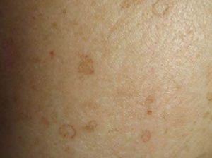 Porokeratosis example