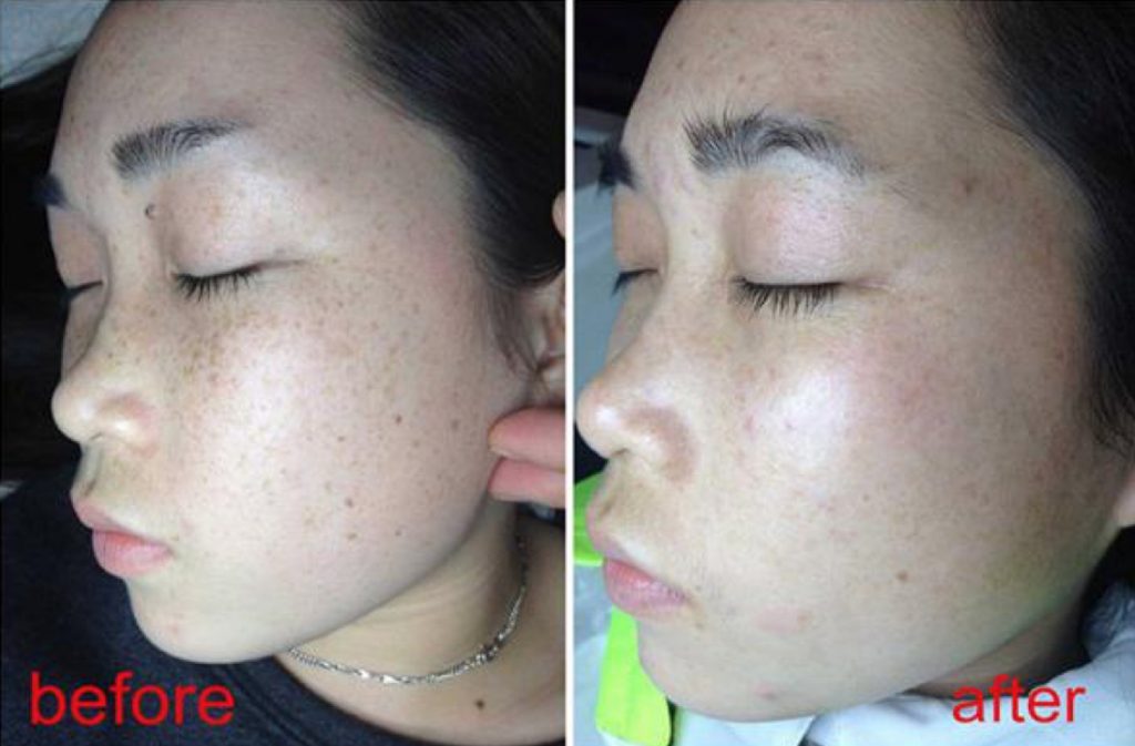 Skin rejuvenation before and after