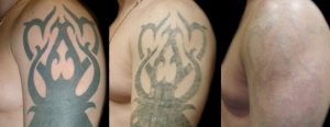 Tattoo before and after