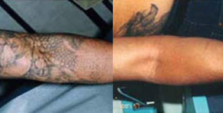 Laser Tattoo Removal  Genesis Lifestyle Medical