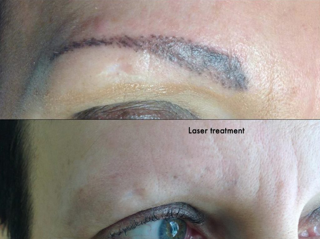 Eyebrow tattoo removal