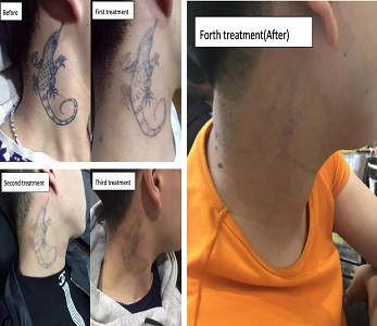 Tattoo removal before & after