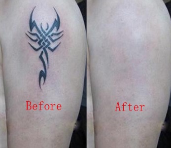 Laser tattoo removal st George salt lake city utah