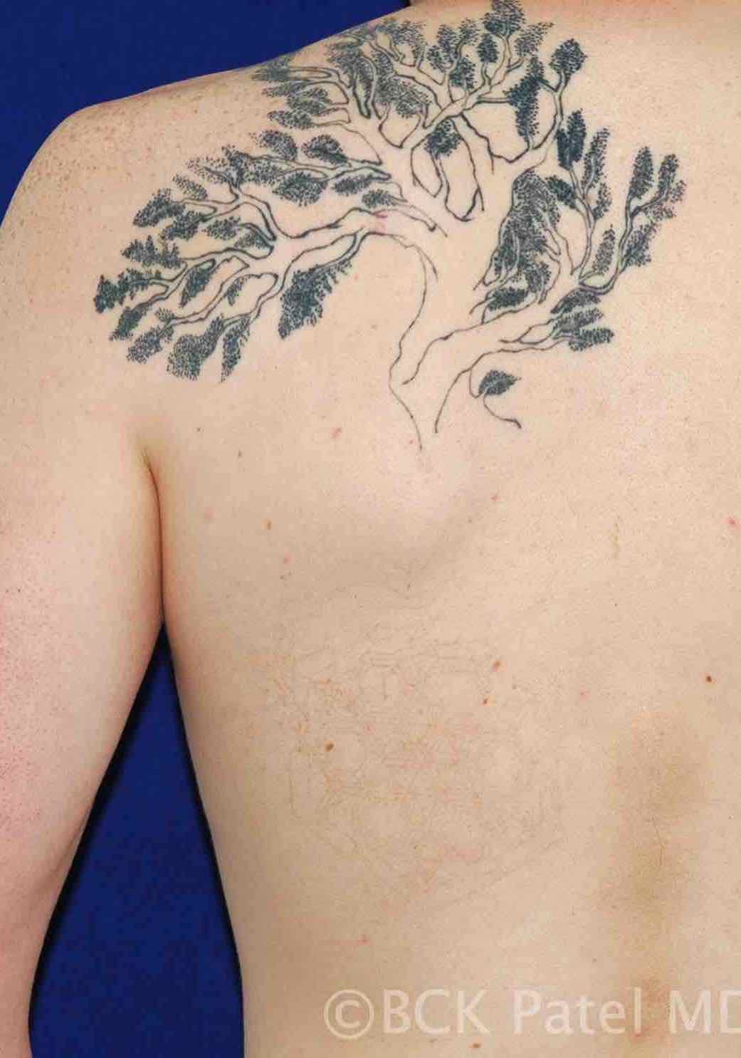 Tattoo removal by Dr. BCK Patel MD, FRCS