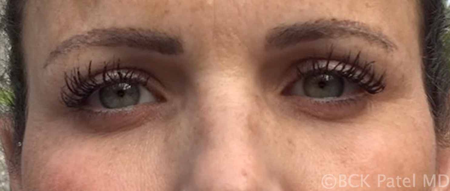 Photo of dark circles around eyes after laser treatment