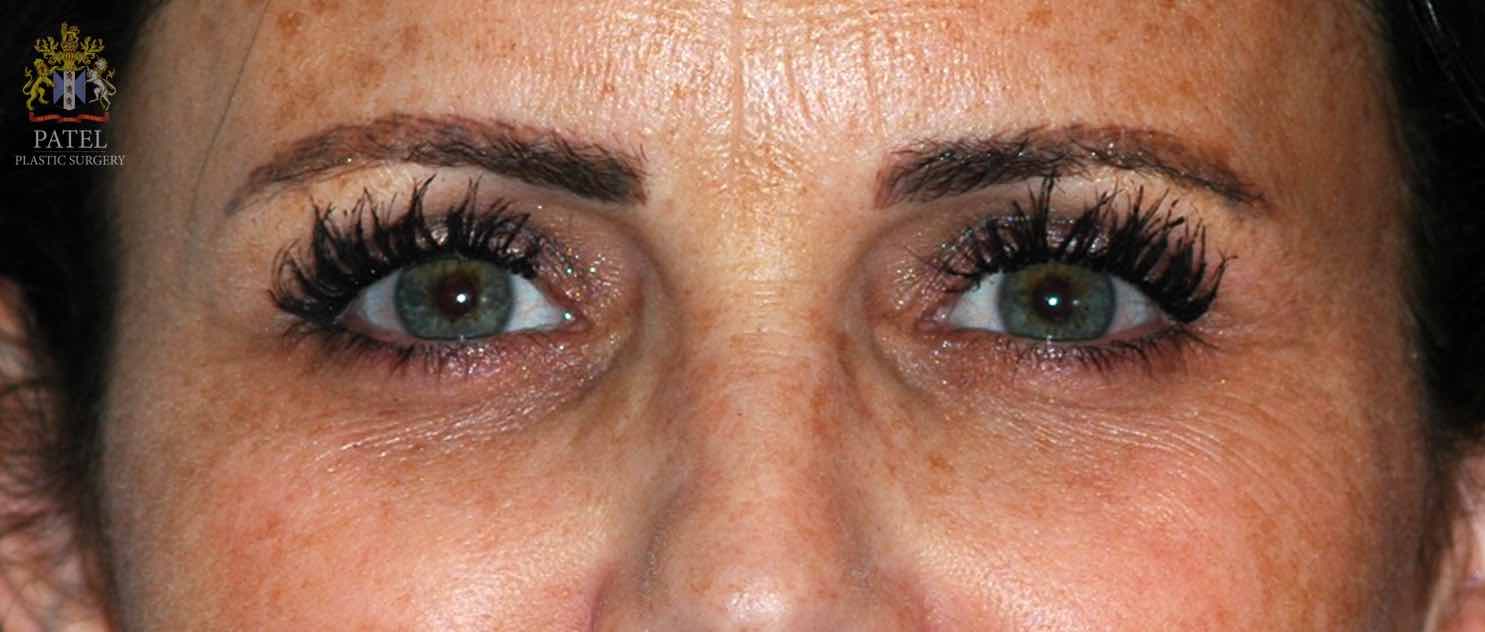 Laser lightening of eye dark circles