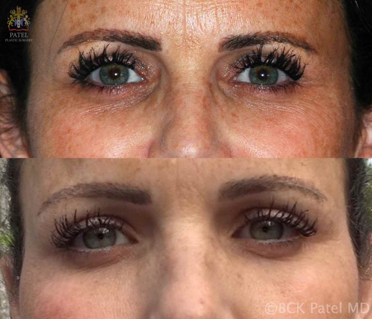 Improvement of dark eyelid circles with laser