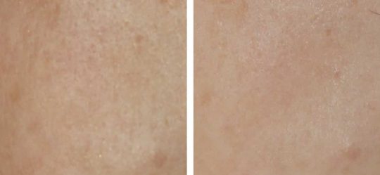 Before & after Carbon laser for pores