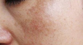 Melasma example-1
