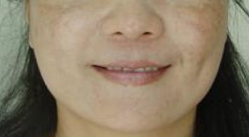 Melasma example-2