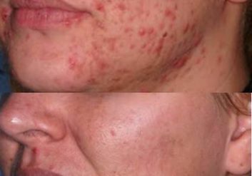 acne vulgaris before & after